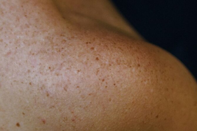 Strawberry Skin Treatment