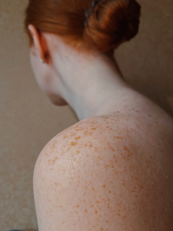 Strawberry Skin Treatment